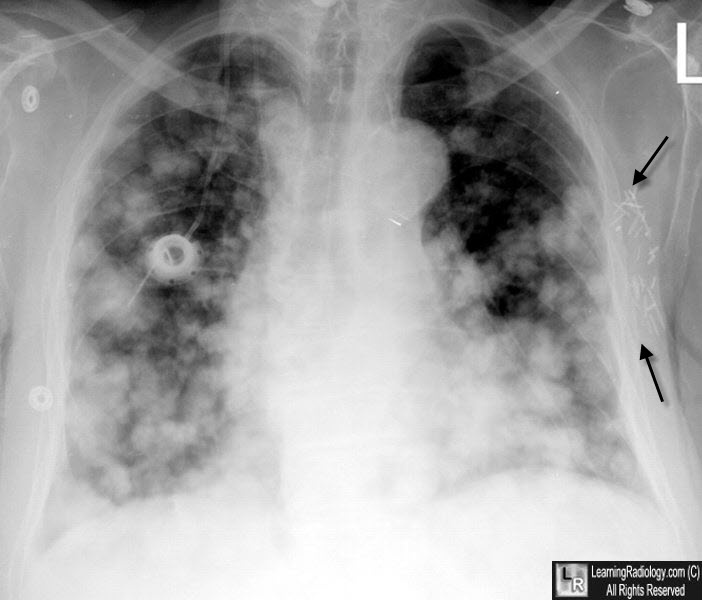 metastases to lung breast carcinoma